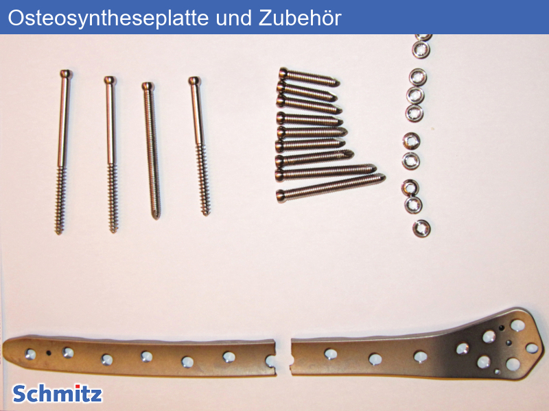 Fatigue fracture of an osteosynthesis plate - 01