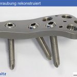 Fatigue fracture of an osteosynthesis plate - 02