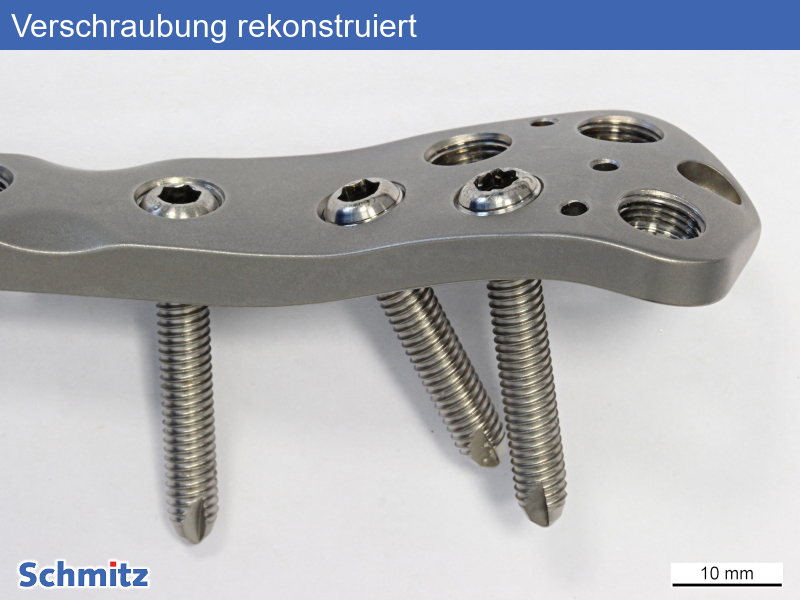 Schwingbruch einer Osteosyntheseplatte - 02