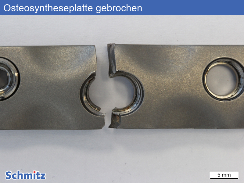 Fatigue fracture of an osteosynthesis plate - 03