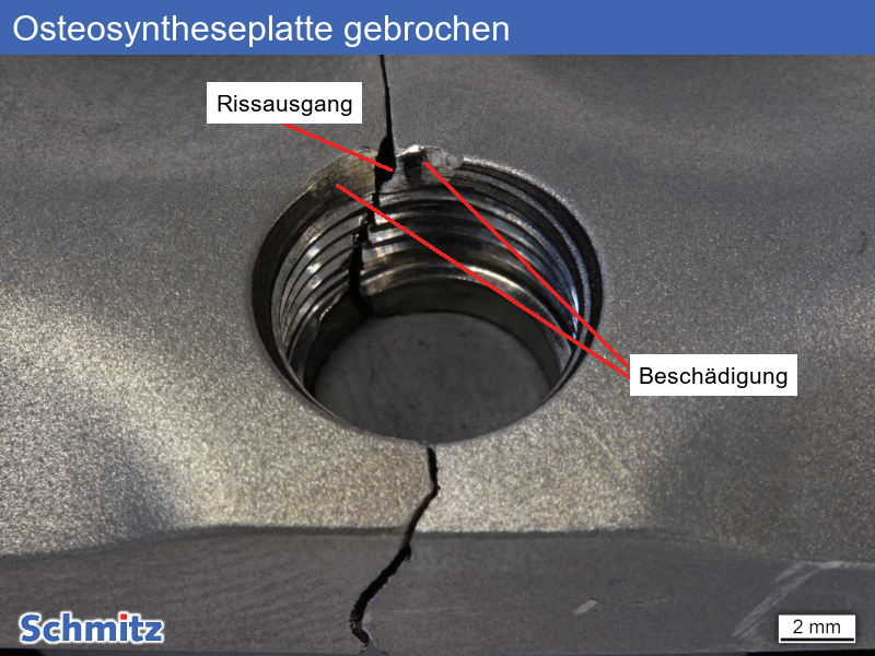 Fatigue fracture of an osteosynthesis plate - 04